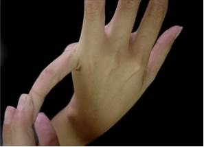 Hipermovilidad articular determinada por el Test de Beighton en ...